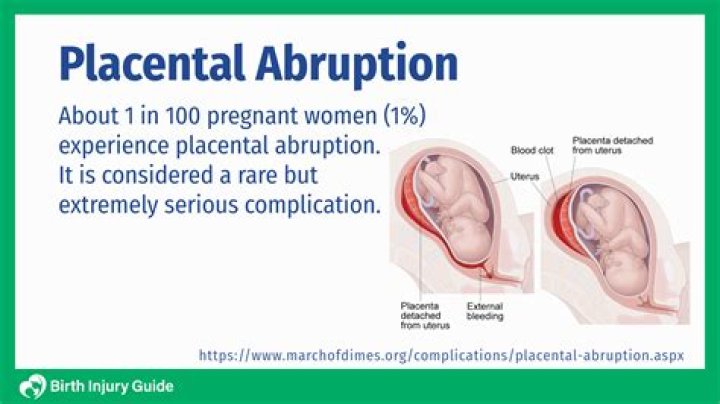 Can a mother die from placental abruption