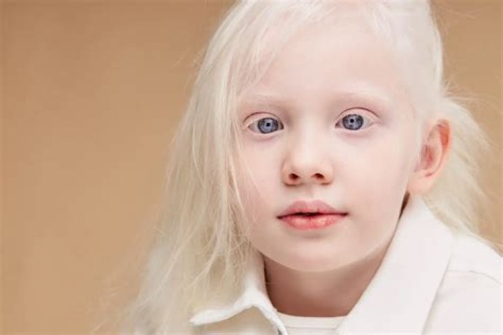 Can an albino have a normal child