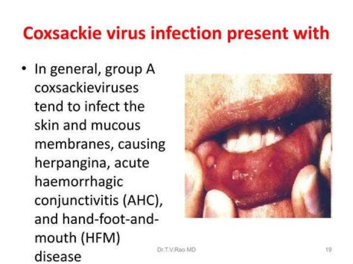 Can Coxsackie virus come back