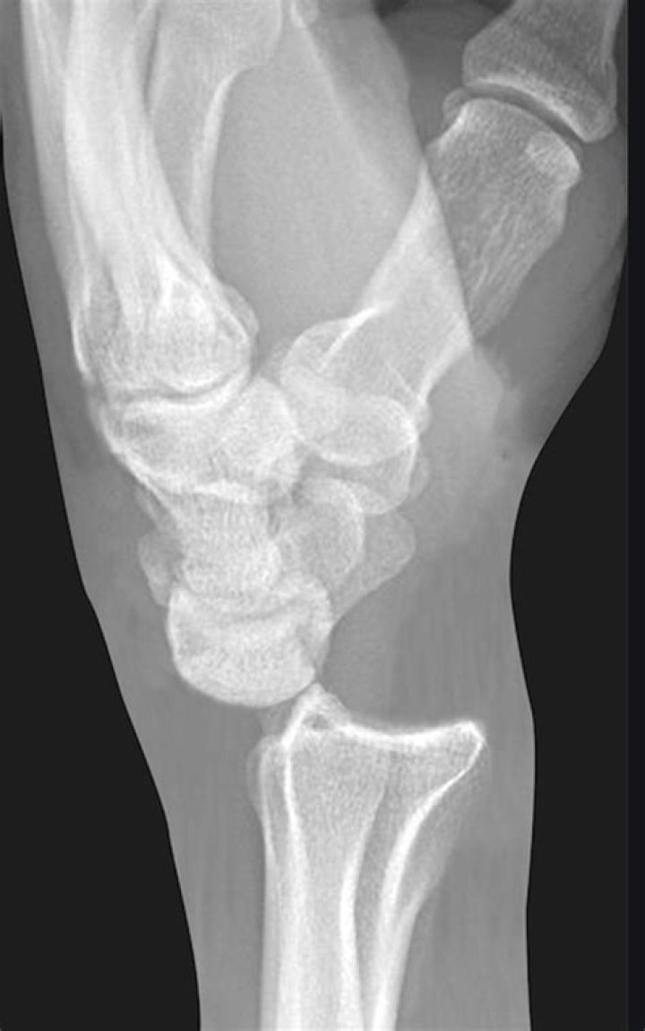 Can you dislocate a carpal bone