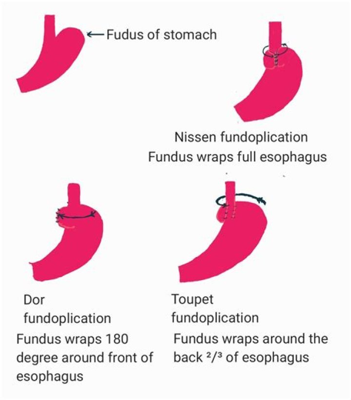 Can you drink coffee after Nissen fundoplication