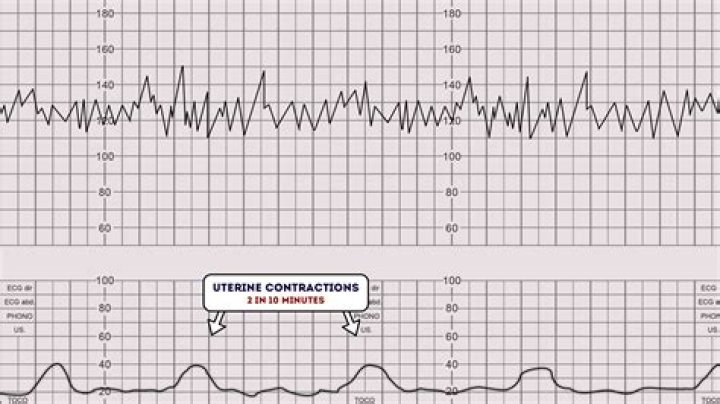 Can you see Braxton Hicks contractions on monitor