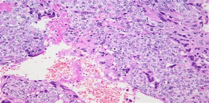 How is choriocarcinoma treated