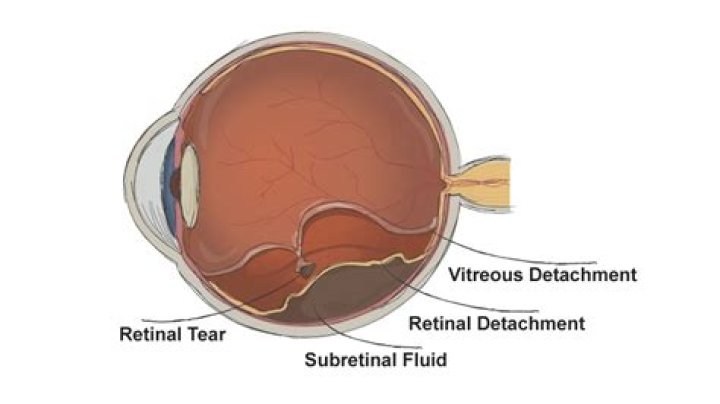 How long is vitreous detachment