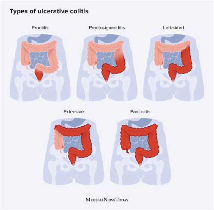 Is ulcerative proctitis the same as ulcerative colitis