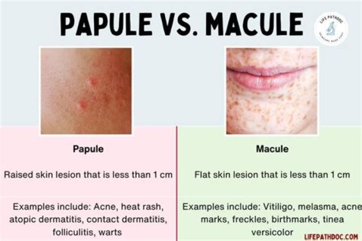 What are Macules and papules
