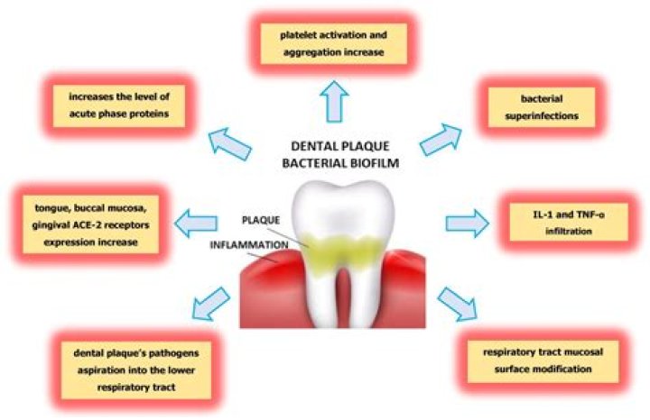 What bacteria causes dental plaque