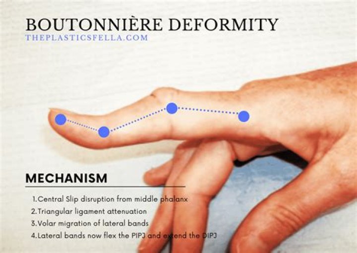 What causes boutonniere deformity