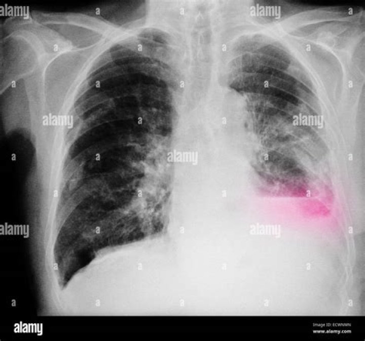 What does a chest X ray look like with lung cancer