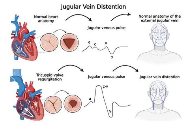 What does bilateral JVD indicate