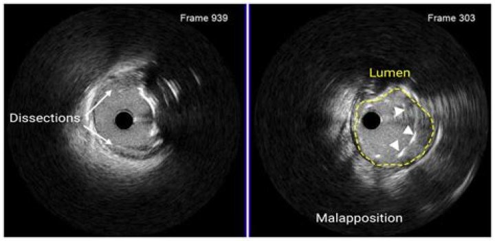What does intraluminal filling defect mean