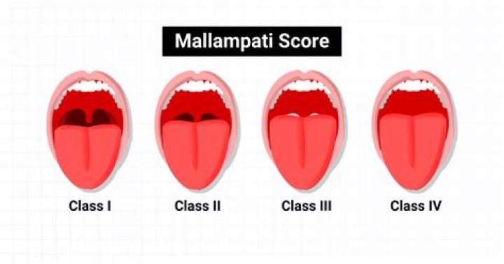 What does the Mallampati score rate