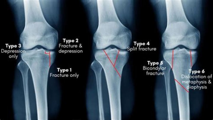 What is a Grade 3 fracture