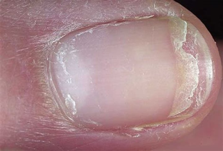 What is Onychoschizia of the nail