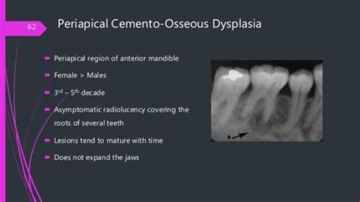 What is periapical Cemento osseous dysplasia
