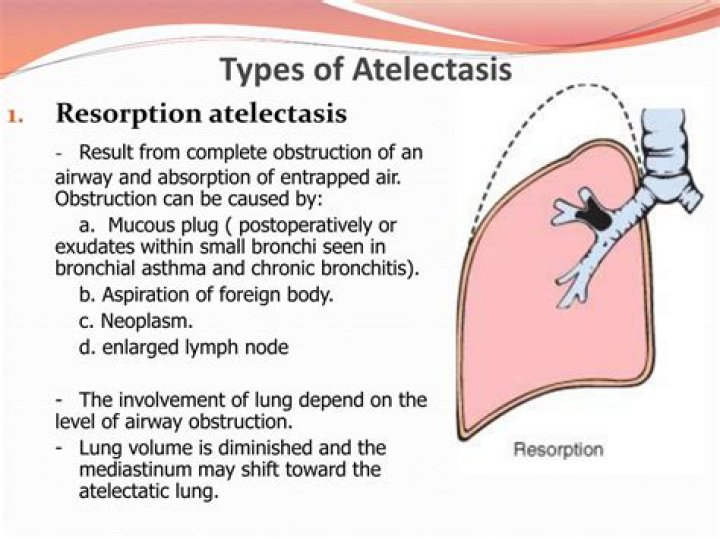 What is resorption atelectasis