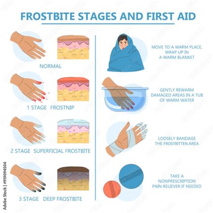 What is the first aid for frostbite