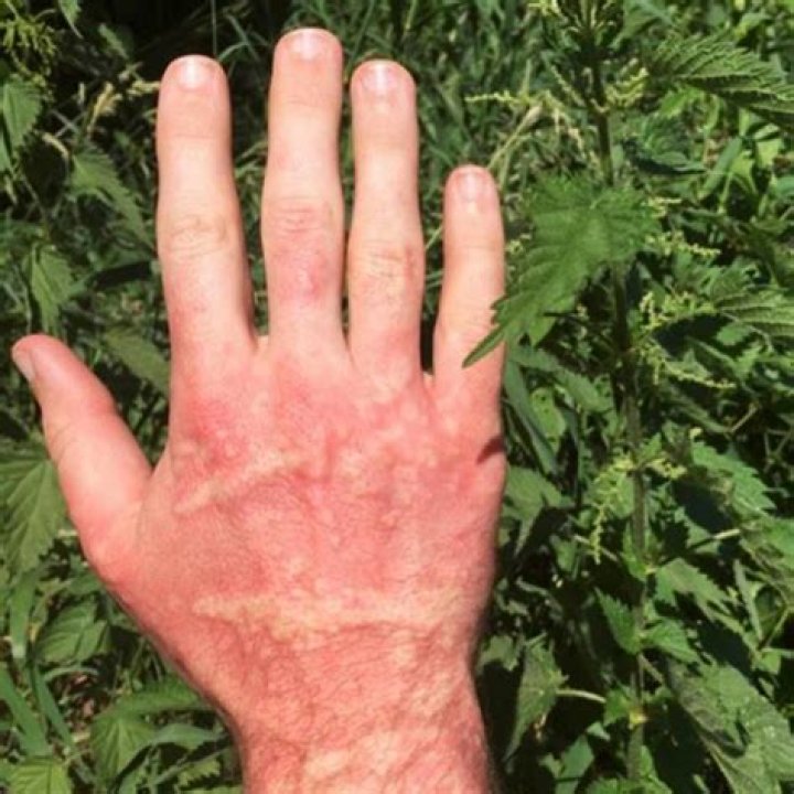 What is the name of the plant that stings
