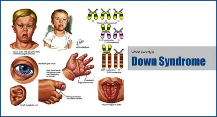 What type of genetic disorder is Down syndrome