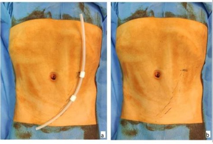 Where is the peritoneal catheter placed