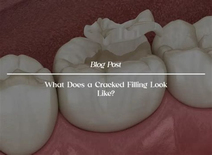 Why did my filling crack
